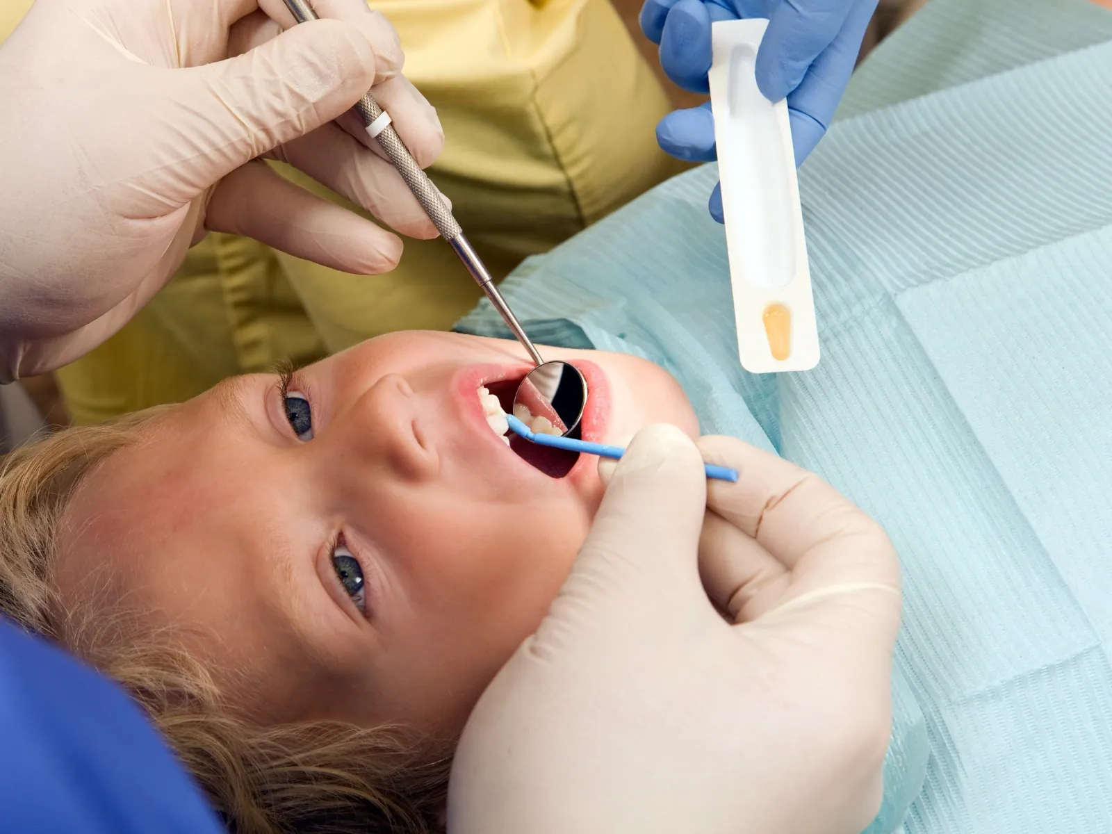 Children's fluoride treatment after a dental visit in Woodridge
