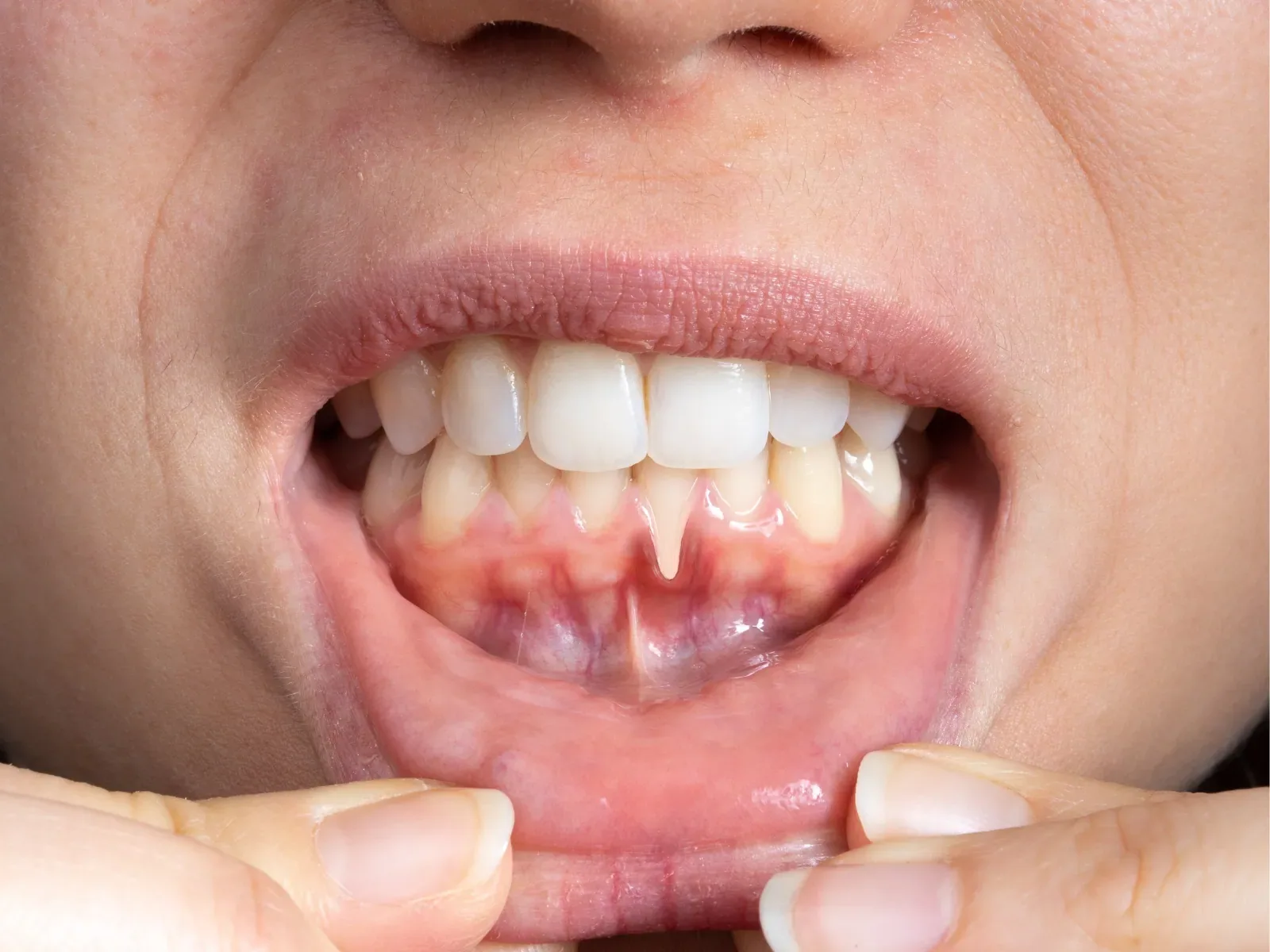Close view of a patient's lower gums and gumline