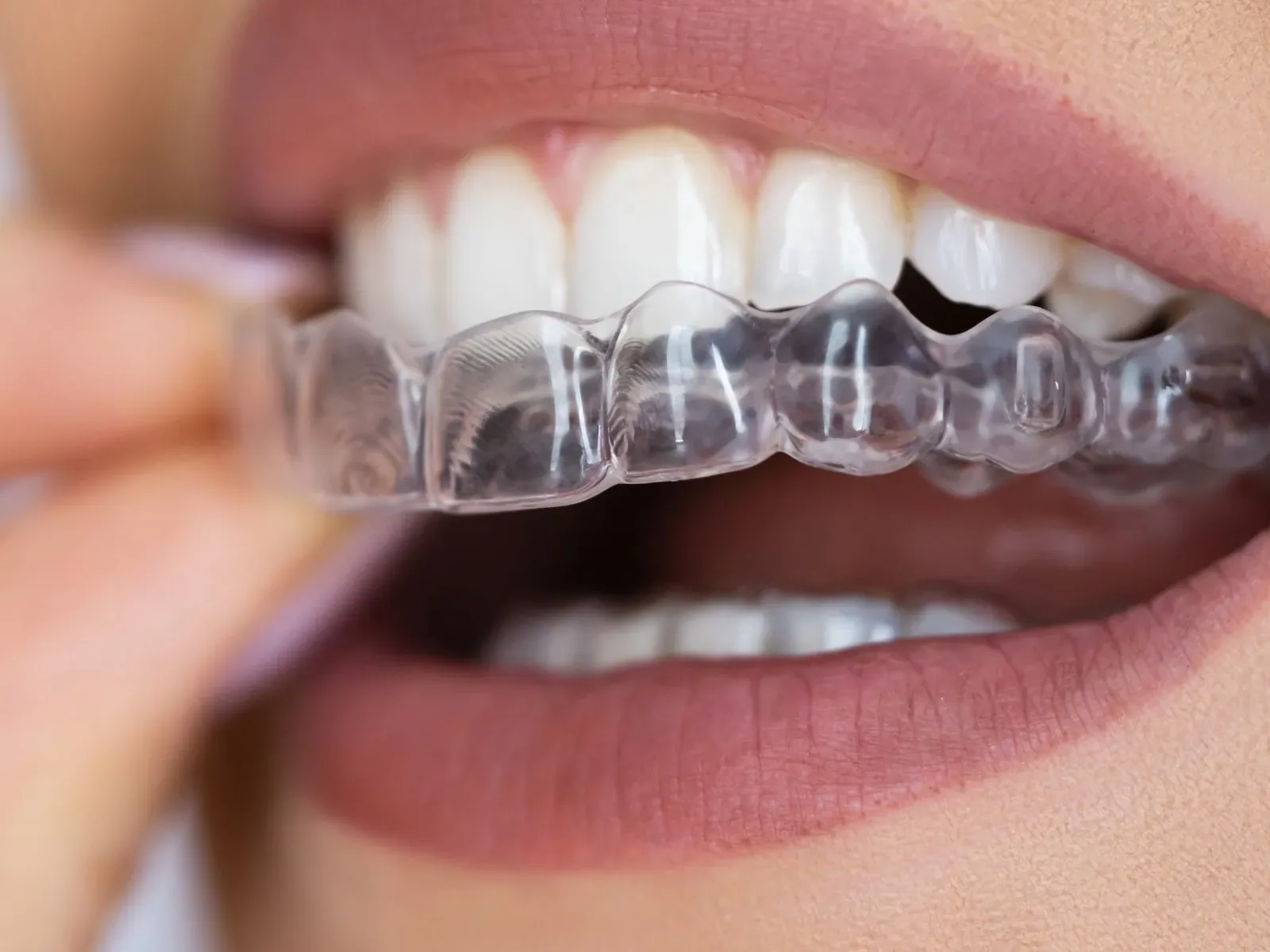 Close view of a clear dental appliance being fitted over upper teeth