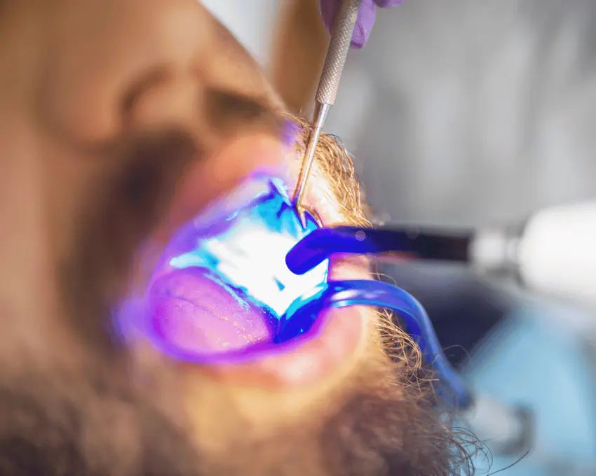 Blue curing light used during a dental restoration