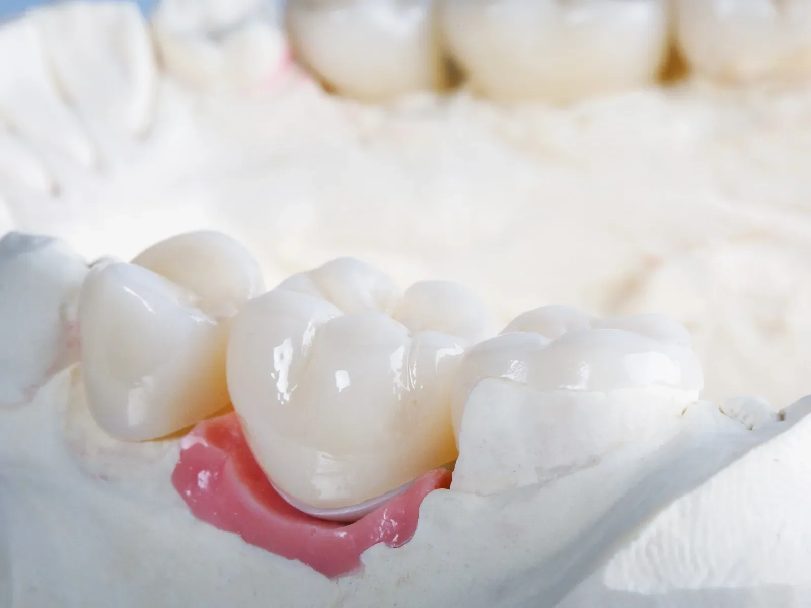 Tooth-colored dental crowns fitted to a model of back teeth